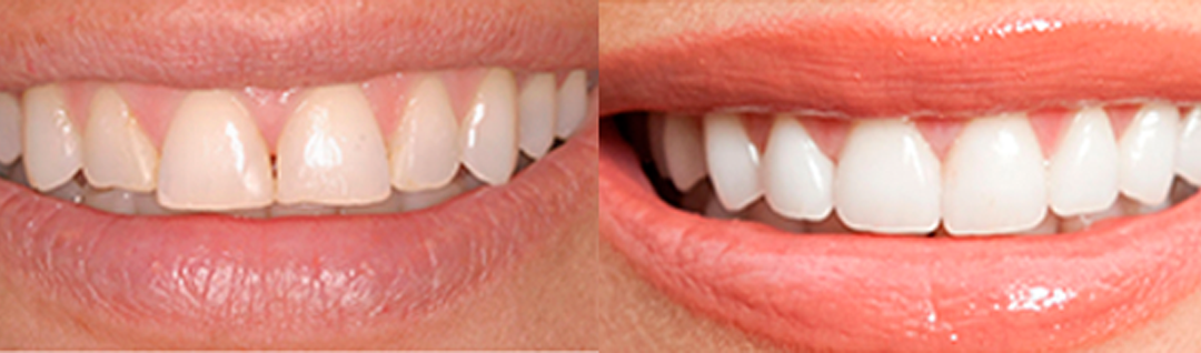 Carillas dentales: Perfeccioná tu sonrisa