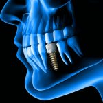 Implantes Dentales Rayos X Enjoy Dental
