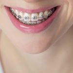Ortodoncia Brackets - Enjoy Dental